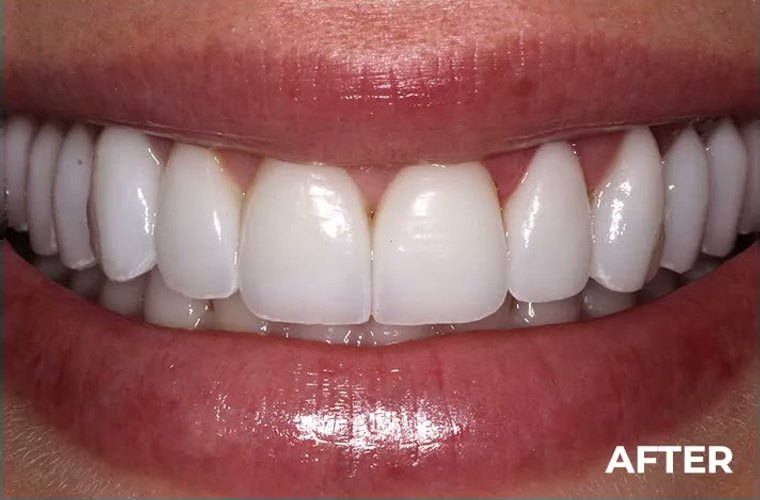 After — veneer smile makeover