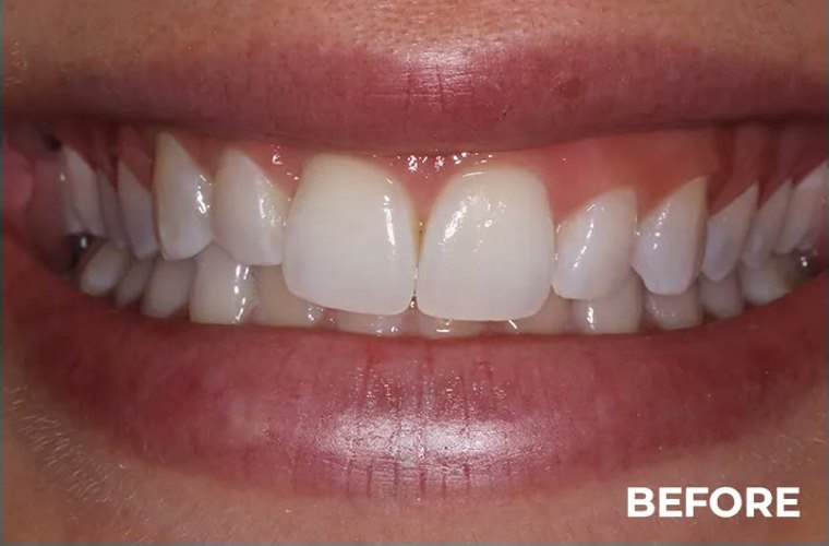 Before — veneer smile makeover