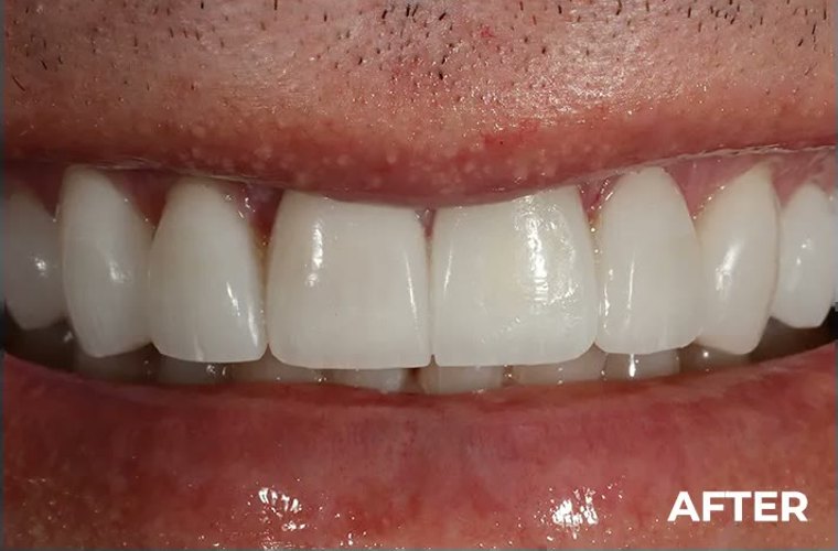 After — whitening and alignment result