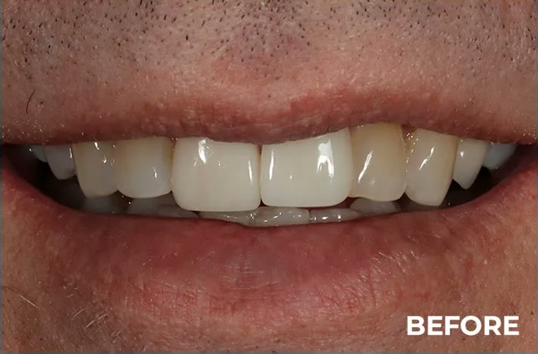 Before — whitening and alignment result