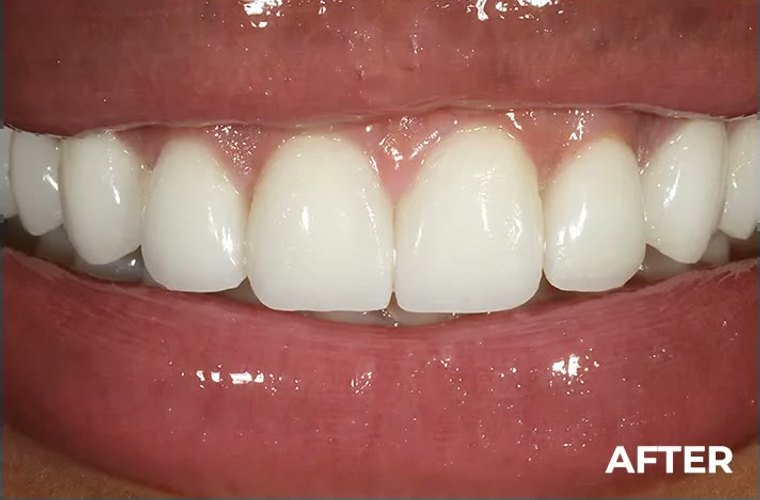 After — front-gap closure result