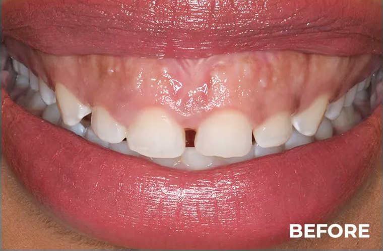 Before — front-gap closure result