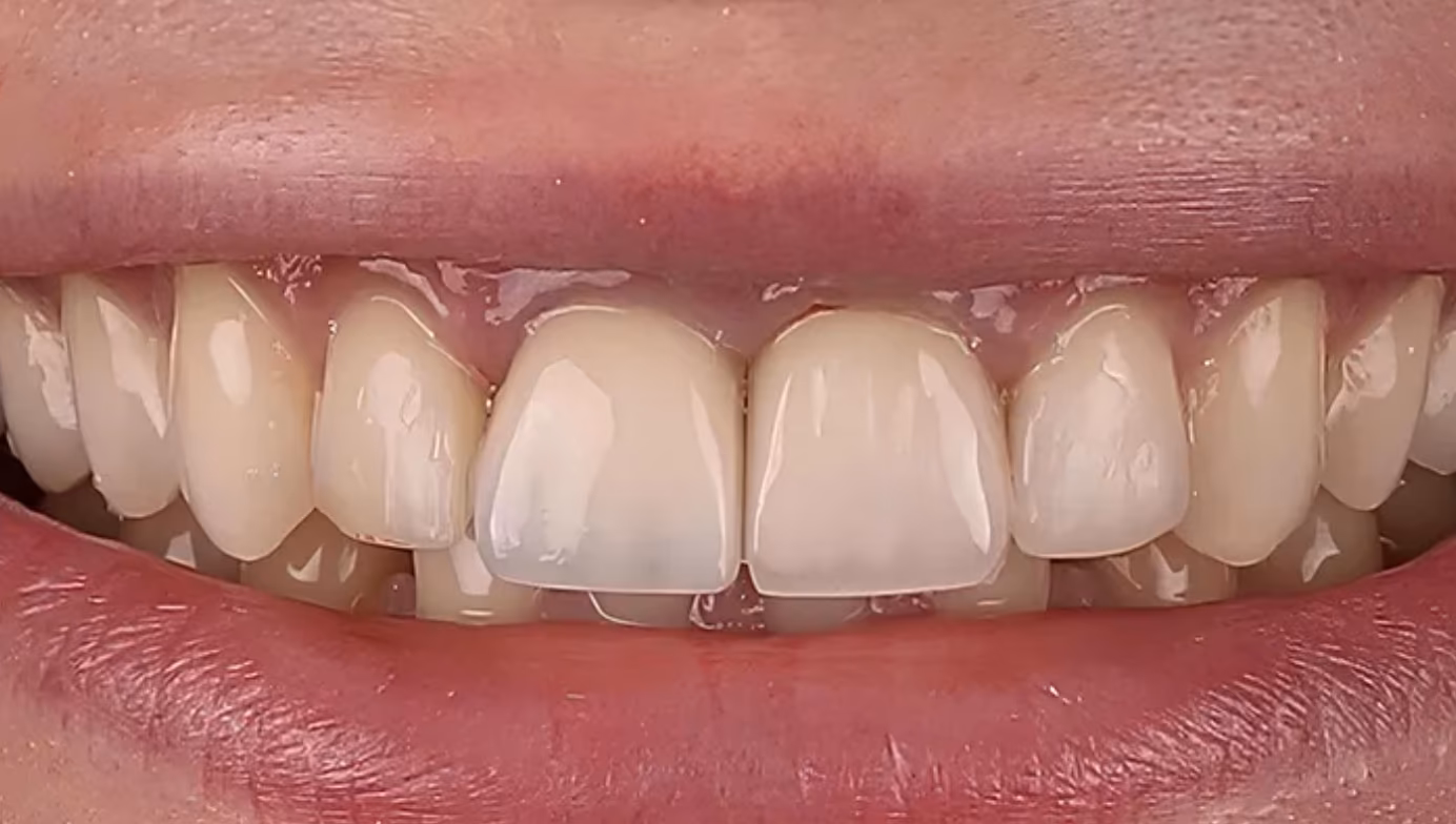 After: two worn, discoloured front teeth rebuilt to match the natural teeth beside them