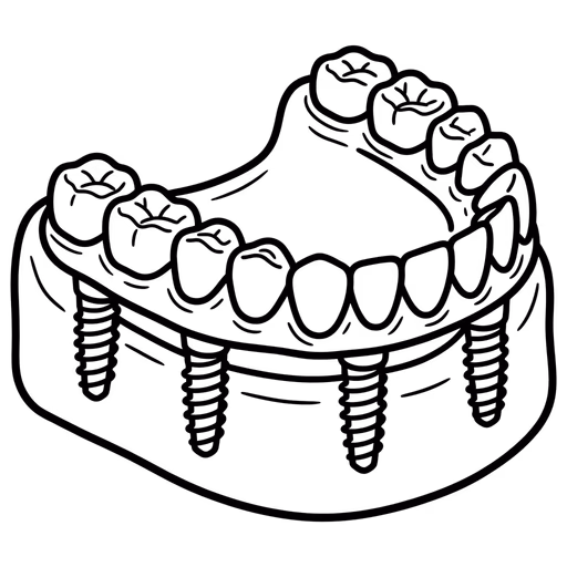 Line drawing of a full arch of teeth fixed permanently onto dental implants