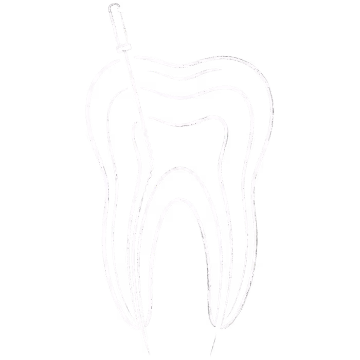 Chalk illustration representing a root canal